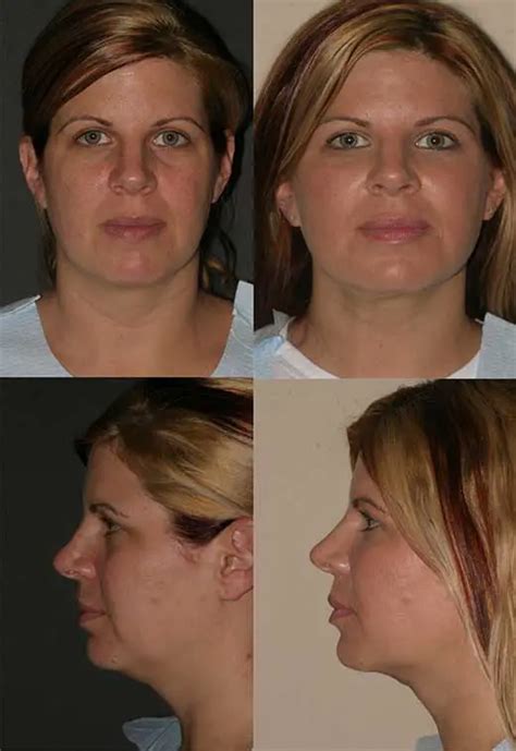 buccal fat removal leeds|8 Buccal Fat Removal doctors in Leeds, United Kingdom.